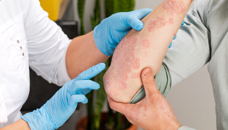 Día Mundial de la Psoriasis: Romper el estigma y alcanzar la remisión